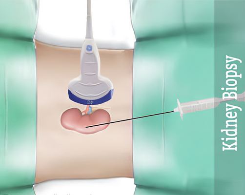 Kidney Renal Biopsy Needle